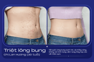 anh truoc sau triet long bung 3