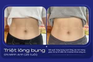 anh truoc sau triet long bung 4