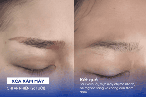 ảnh trước sau xóa xăm mày 1