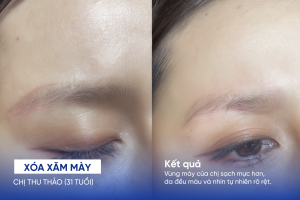 ảnh trước sau xóa xăm mày 4