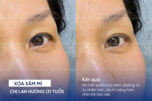 ảnh trước sau xóa xăm mí 1