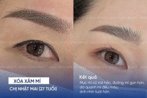 ảnh trước sau xóa xăm mí 2