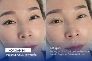 ảnh trước sau xóa xăm mí 3
