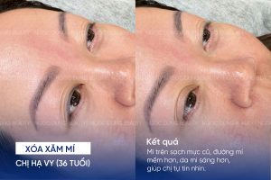ảnh trước sau xóa xăm mí 4