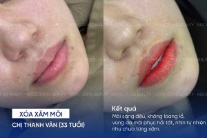 ảnh trước sau xóa xăm môi 1