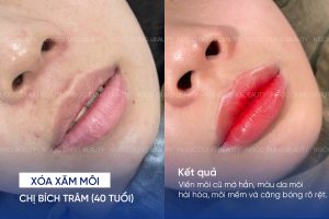 ảnh trước sau xóa xăm môi 2