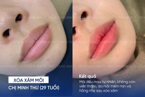 ảnh trước sau xóa xăm môi 3