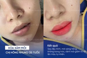 ảnh trước sau xóa xăm môi 4