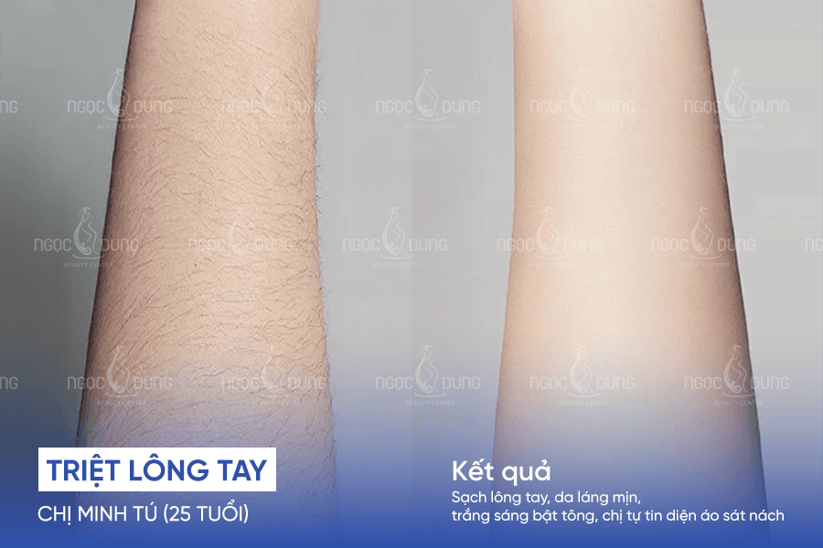 Từ vùng tay nhiều lông đến bề mặt da mịn và chỉn chu hơn sau liệu trình tại Ngọc Dung