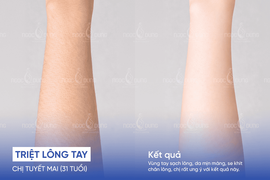 Giảm tình trạng lông tay kém thẩm mỹ, giúp bề mặt da trở nên mượt và đều hơn