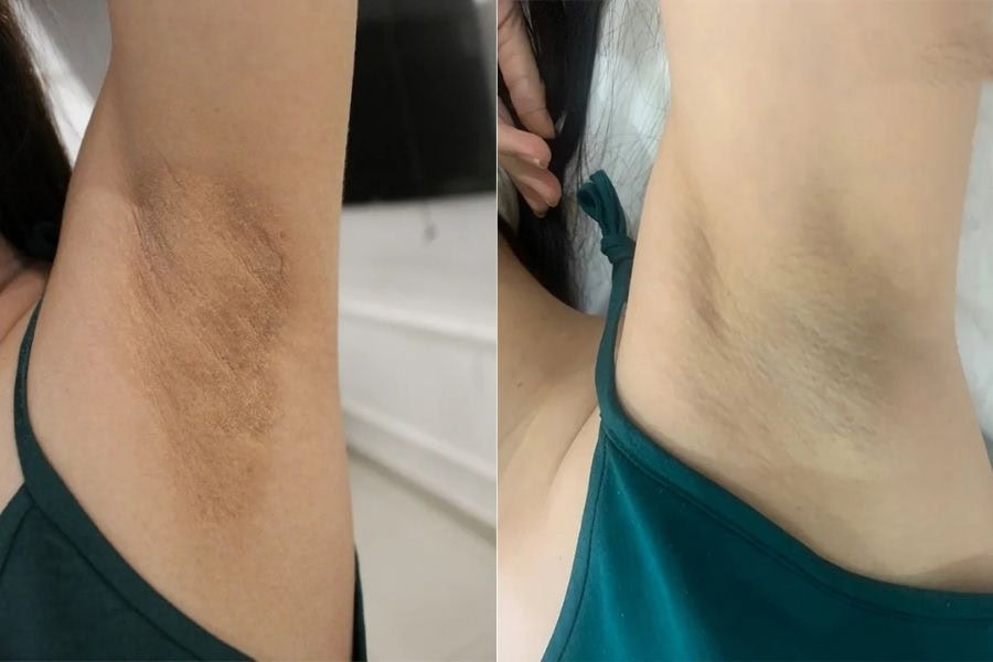 Dùng kem tẩy lông nách không phải là nguyên nhân chính gây ra thâm nách