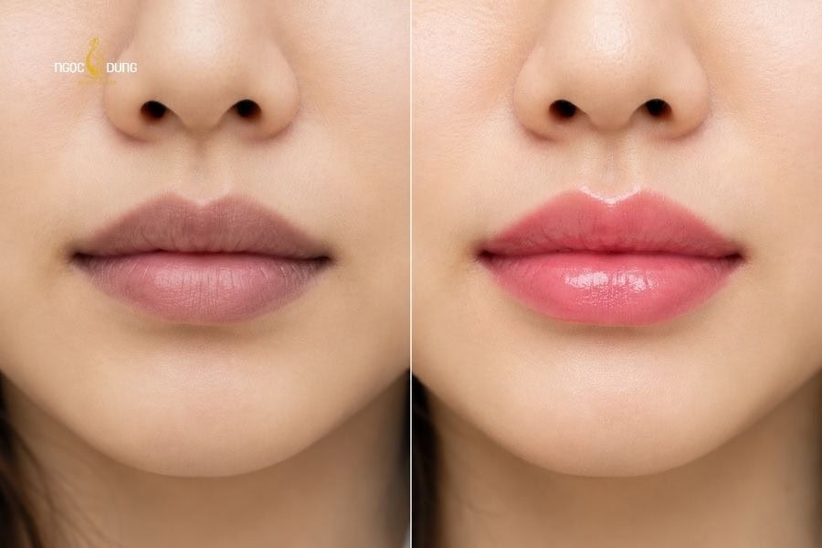 Phun môi collagen bảng màu và giá chi tiết ở Ngọc Dung 4 Phun môi collagen đặc biệt phù hợp với môi thâm sạm và khô