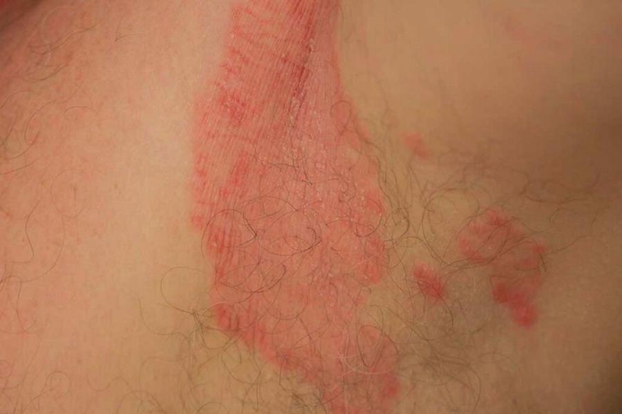 Kem tẩy lông nách cũng có nguy cơ gây viêm da nên bạn cần thận trọng khi sử dụng