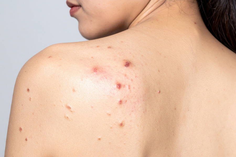 Chi phí điều trị mụn giá bao nhiêu? Bảng giá mới 2026 7 Tình trạng và loại mụn thực tế ảnh hưởng rất lớn tới chi phí trị mụn