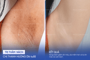 Chị Thanh Hương (34 tuổi) - Trị thâm nách