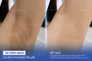 Chị Bích Phượng (31 tuổi) - Trị thâm nách