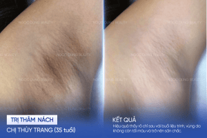 Chị Thùy Trang (35 tuổi) - Trị thâm nách