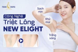 Triệt lông bằng công nghệ New Elight có tốt không?