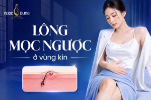 Lông mọc ngược ở vùng kín: Nguyên nhân và cách xử lý