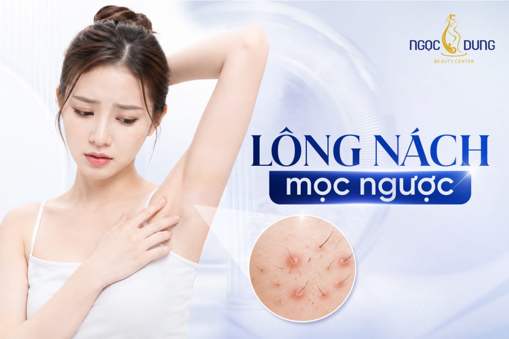 Lông nách mọc ngược: Nguyên nhân và cách điều trị
