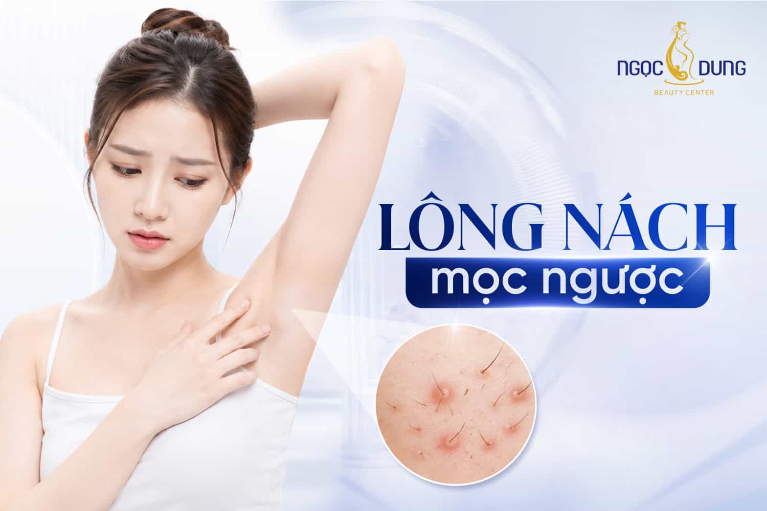 Lông nách mọc ngược: Nguyên nhân và cách điều trị