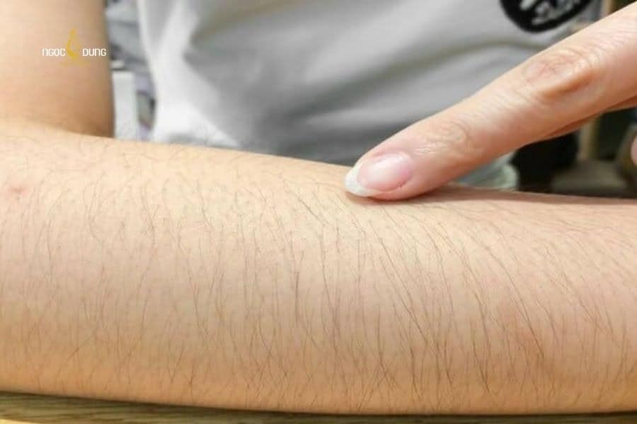 DPL mang lại kết quả tốt hơn đối với da sáng và lông đậm màu