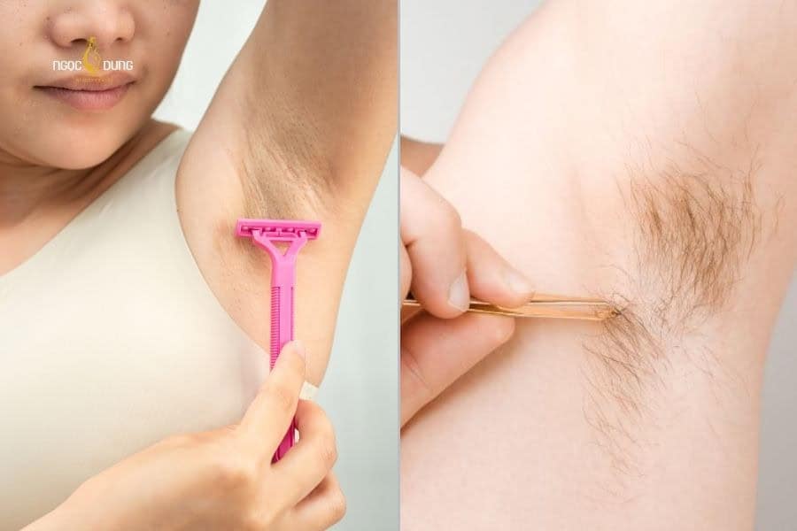 Nhổ và cạo đều là hai phương pháp loại bỏ lông nách phổ biến