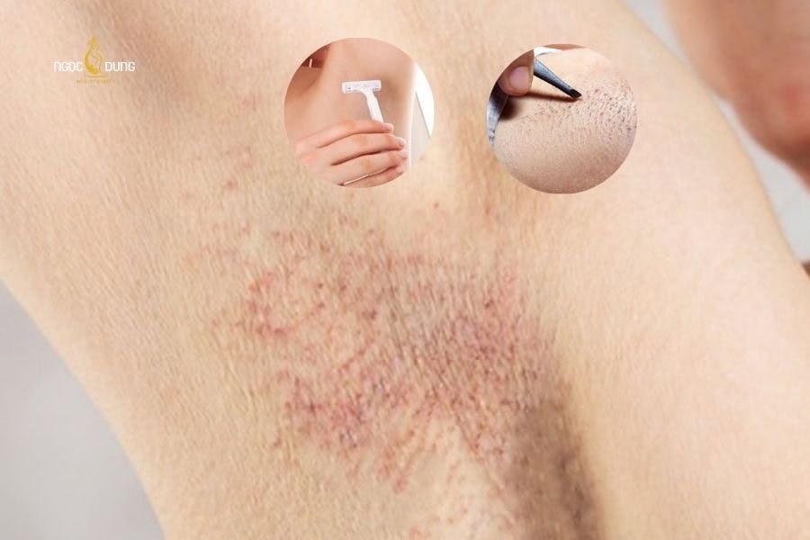 Cạo hoặc nhổ lông nách liên tục có thể gây thâm và sẹo ở nách