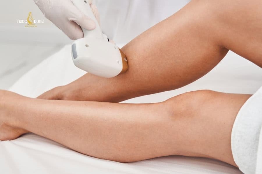 Hiệu quả triệt lông với Laser có thể lên đến 80%