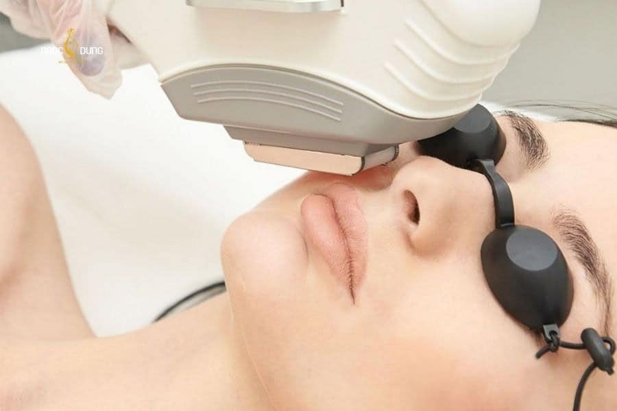 Triệt lông mặt đúng cách hỗ trợ ngừa viêm nang lông