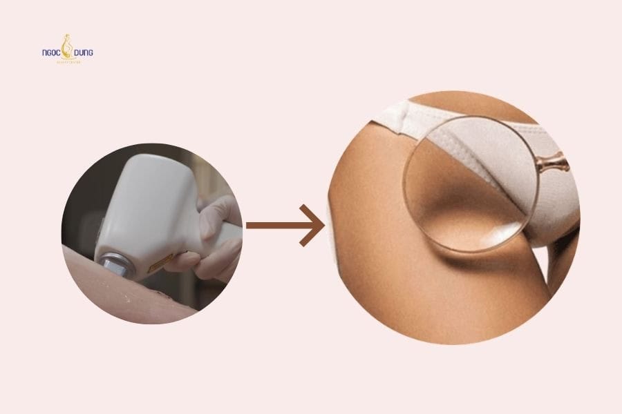 Triệt lông có thể gây thâm nếu chọn sai phương pháp