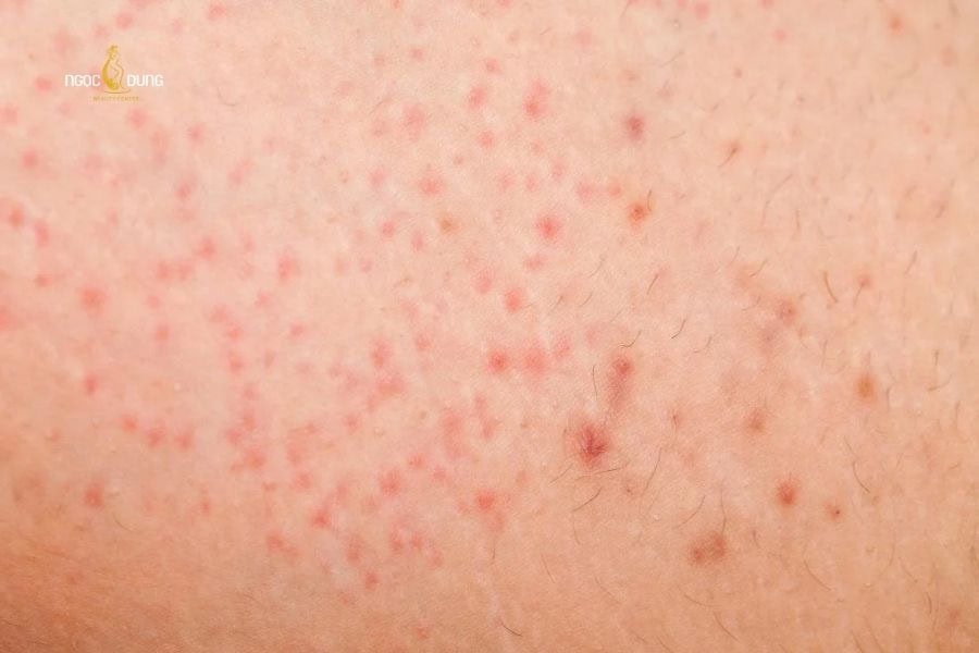 Da dễ bị dị ứng hơn nếu triệt lông vùng kín tại nhà sai kỹ thuật