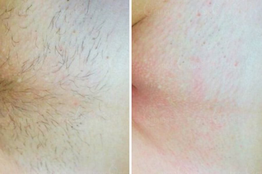 Triệt lông vùng kín giúp tăng thẩm mỹ sạch sẽ và thông thoáng