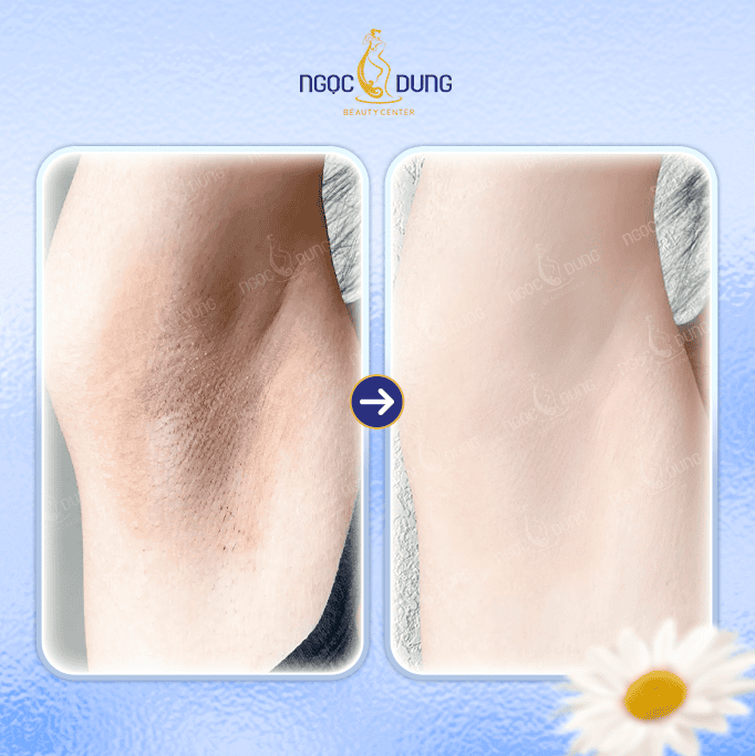 TRỊ THÂM NÁCH SALE SỐC