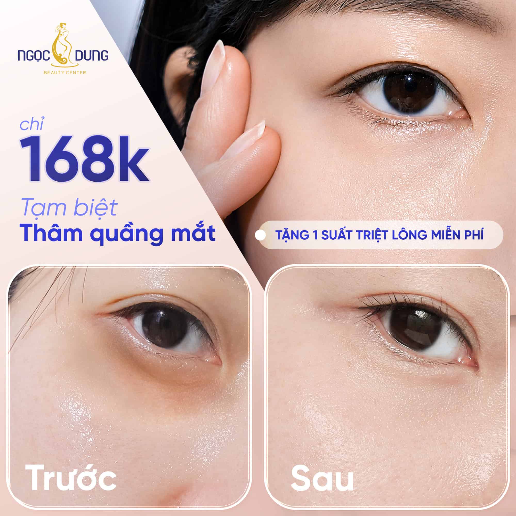 TRỊ THÂM QUẦNG MẮT LASER THẾ HỆ MỚI