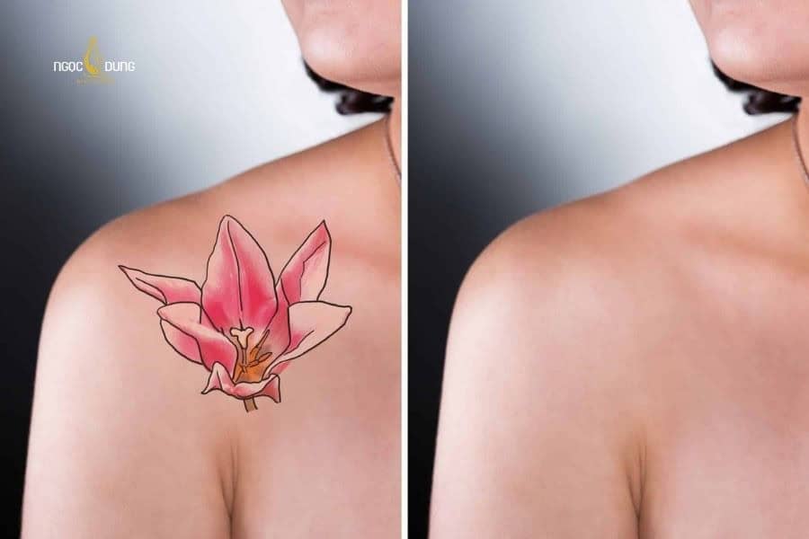 Cần tối thiểu 6 buổi để thấy rõ kết quả xóa xăm