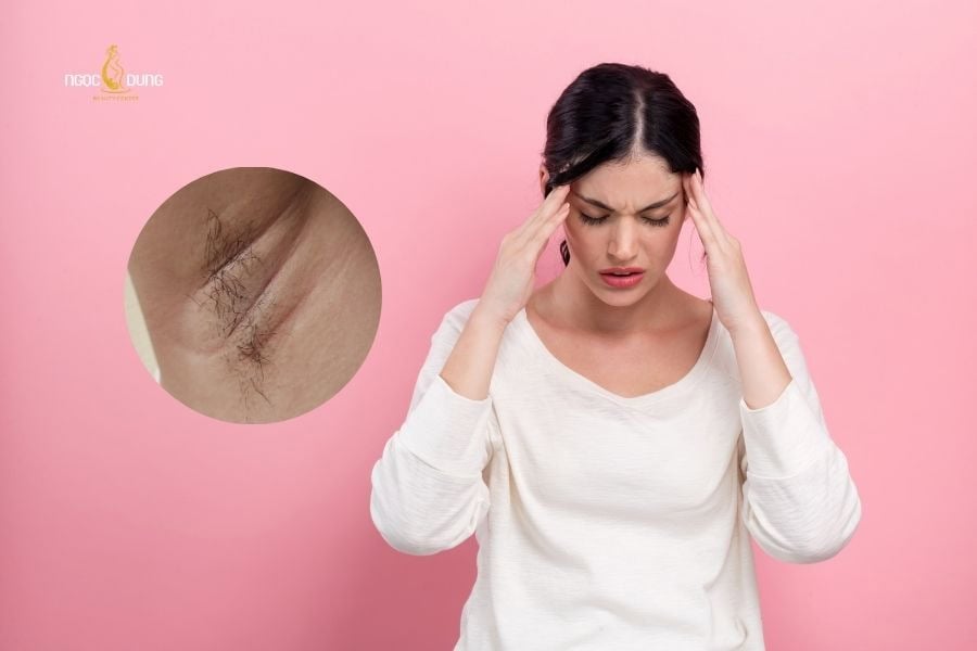 Giải đáp tiếp theo của thắc mắc tại sao lông nách mọc nhanh là do căng thẳng