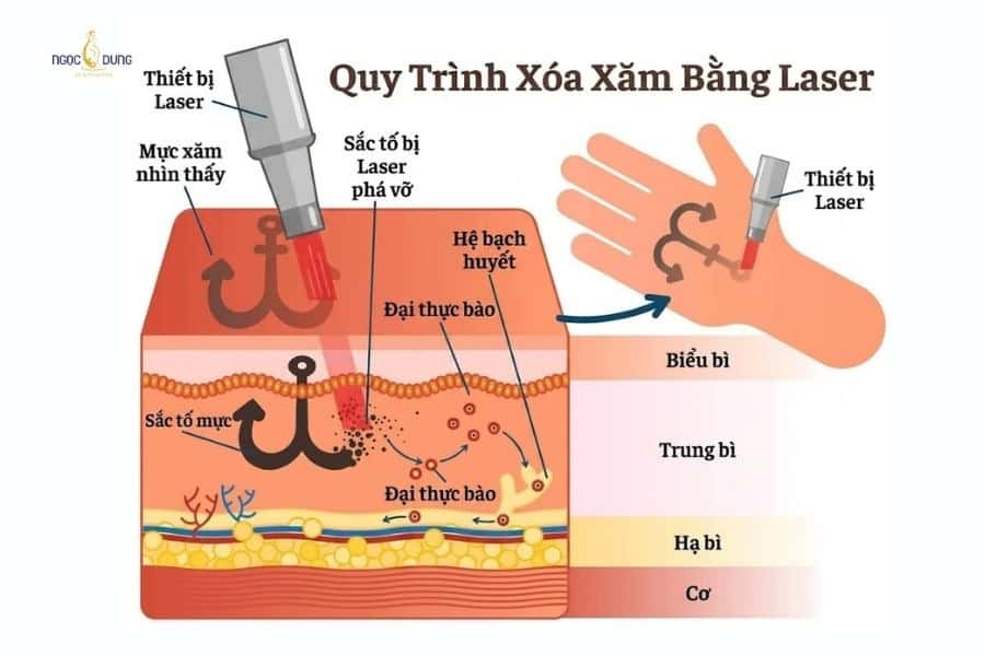 Cách công nghệ xóa xăm hoạt động