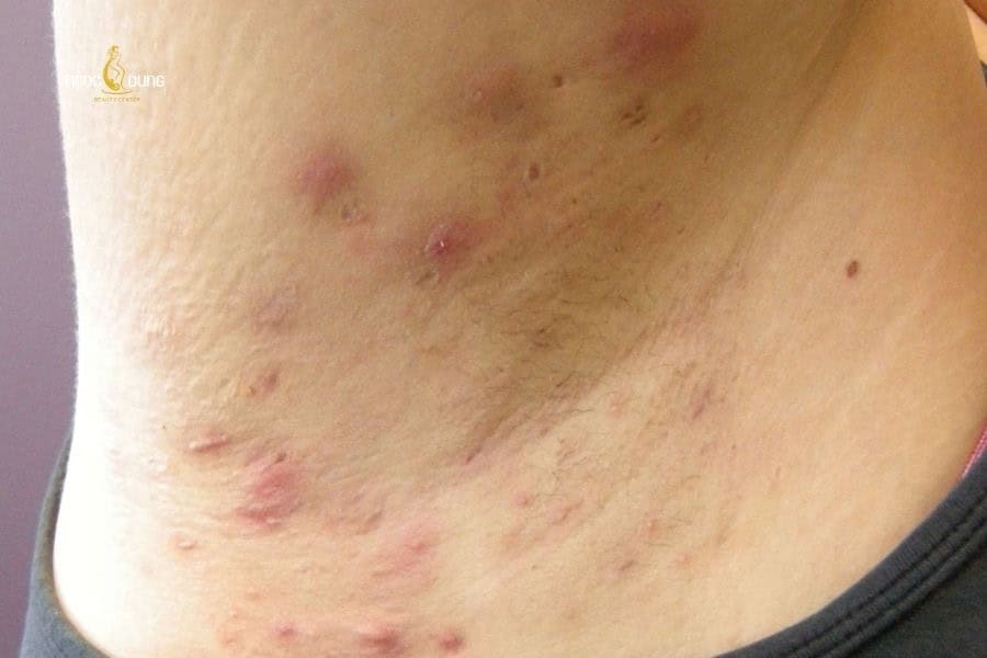 Cơ địa nhạy cảm cũng là giải đáp phổ biến cho thắc mắc tại sao mọc lông nách lại ngứa