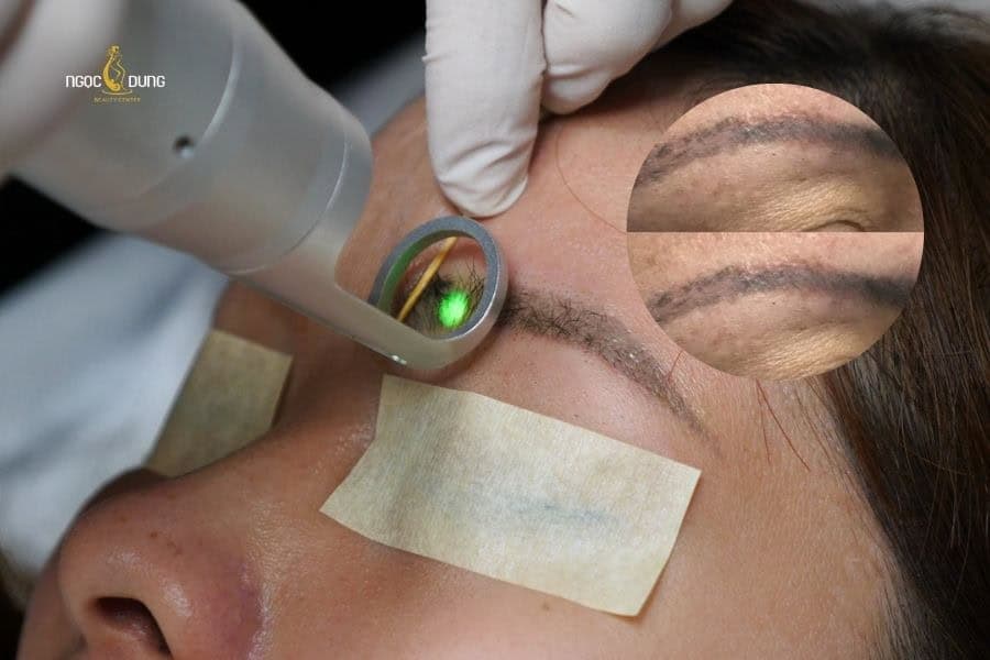 Giá xóa xăm chân mày còn phụ thuộc vào tình trạng thẩm mỹ hiện tại