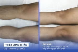 Ngọc Dung mang đến giải pháp triệt lông chân không đau không kích ứng cho khách hàng
