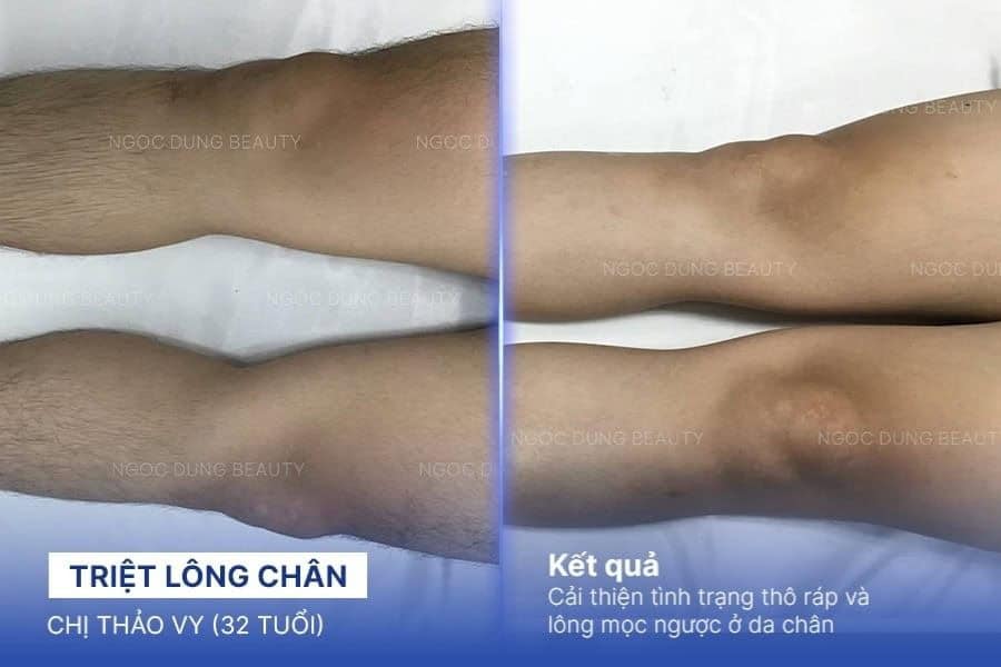 Ngọc Dung mang đến giải pháp triệt lông chân không đau không kích ứng cho khách hàng
