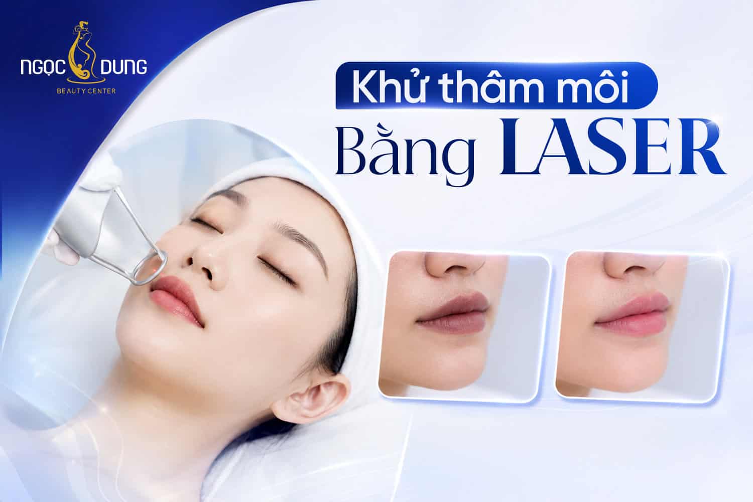 Khử thâm môi bằng Laser