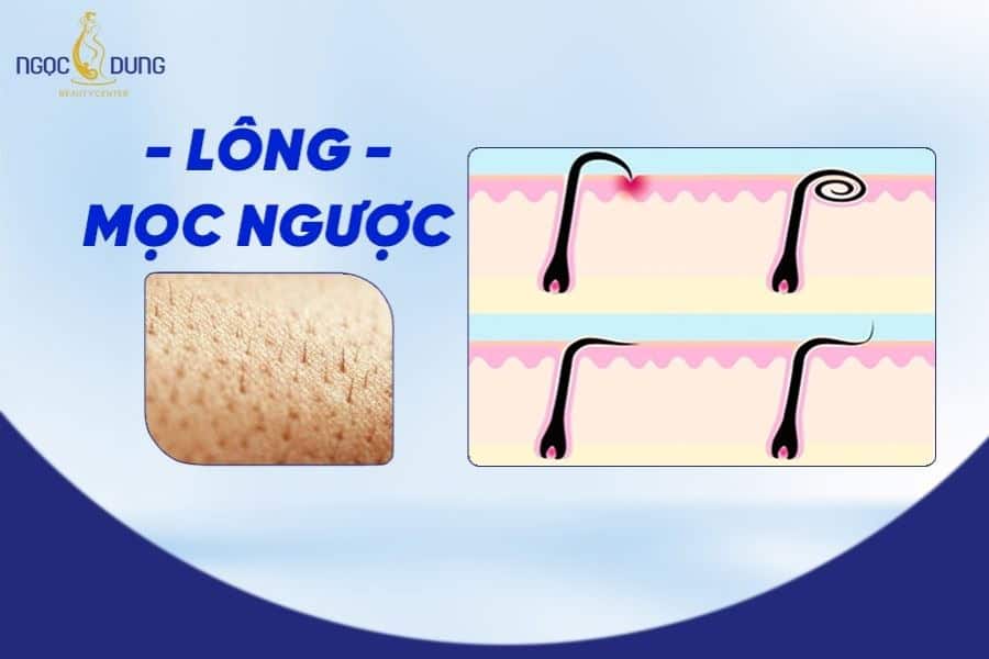 Lông mọc ngược cũng có thể gây tình trạng ngứa ở vùng cánh