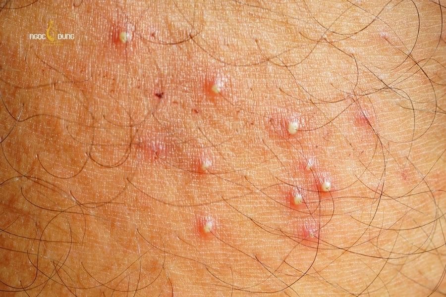 Lông mọc ngược ở vùng kín thường biểu hiện thành các nốt mụn li ti