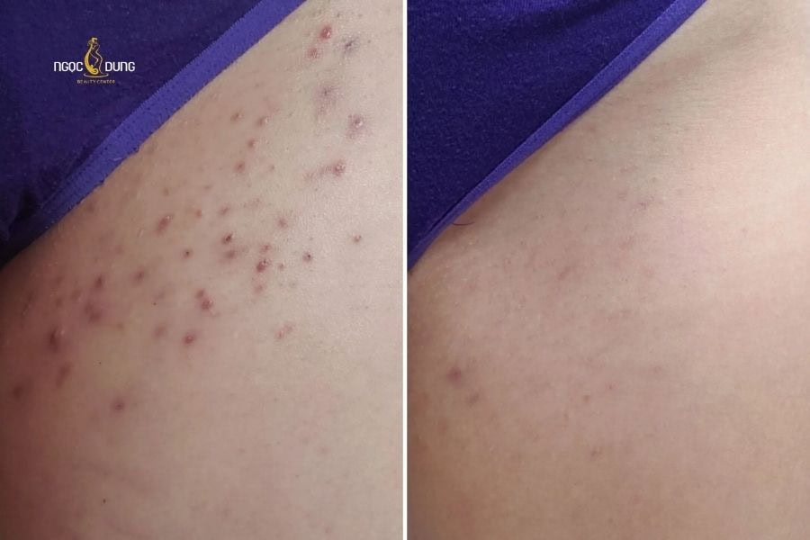Tình trạng vùng kín bị lông mọc ngược có thể tự hết sau 2 tuần
