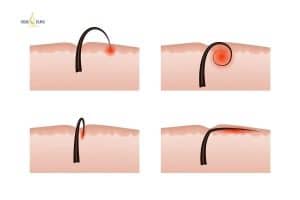 Lông nách mọc ngược là tình trạng lông mọc bên dưới da