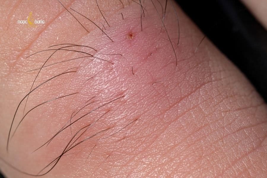 Cơ địa lông xoăn dày thường dễ gặp tình trạng lông nách bị mọc ngược