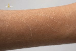 Lông tay có màu trắng là hiện tượng sinh lý bình thường