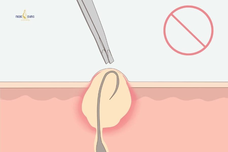 Hãy đảm bảo vệ sinh khi xử lý tình trạng lông mọc ngược ở  vùng kín